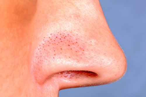 blackheads on nose blackheads on nose